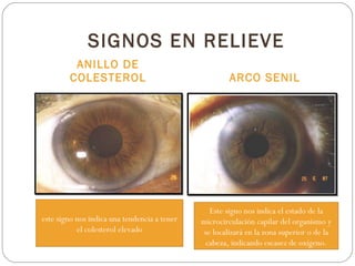 SIGNOS EN RELIEVE ANILLO DE COLESTEROL ARCO SENIL Este signo nos indica el estado de la microcirculación capilar del organismo y se localizará en la zona superior o de la cabeza, indicando escasez de oxígeno. este signo nos indica una tendencia a tener el colesterol elevado 