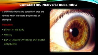 CONCENTRIC NERVE/STRESS RING
Concentric circles and portions of arcs are
formed when the fibers are pinched or
cramped
Indication
• Stress in the body
• Anxiety
• Sign of physical irritations and mental
disturbances
 
