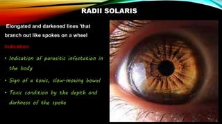 RADII SOLARIS
Elongated and darkened lines 'that
branch out like spokes on a wheel
Indication
• Indication of parasitic infestation in
the body
• Sign of a toxic, slow-moving bowel
• Toxic condition by the depth and
darkness of the spoke
 