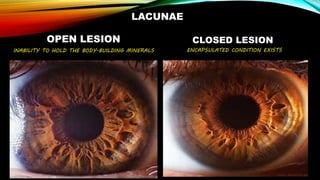 LACUNAE
OPEN LESION
INABILITY TO HOLD THE BODY-BUILDING MINERALS
CLOSED LESION
ENCAPSULATED CONDITION EXISTS
 