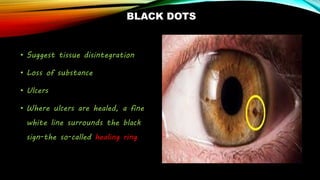 BLACK DOTS
• Suggest tissue disintegration
• Loss of substance
• Ulcers
• Where ulcers are healed, a fine
white line surrounds the black
sign-the so-called healing ring
 