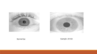 Normal Eye Example of Irish
 