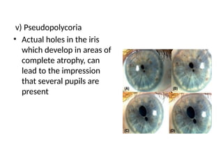 Polykorie IRIS & CILIARY BODY ANATOMY AND STRUCTURE | PPTX