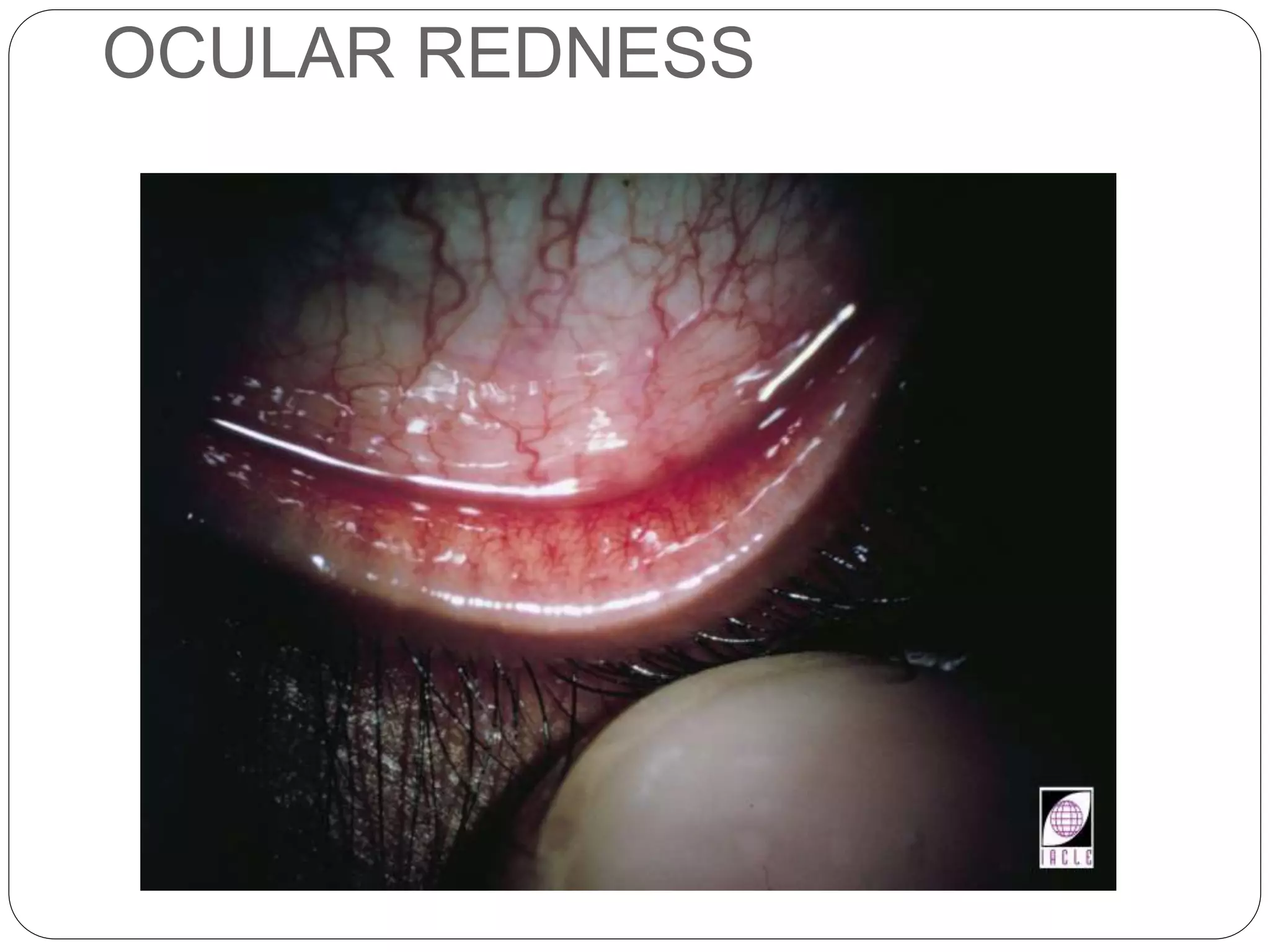 OCULAR REDNESS
SIGNS
 