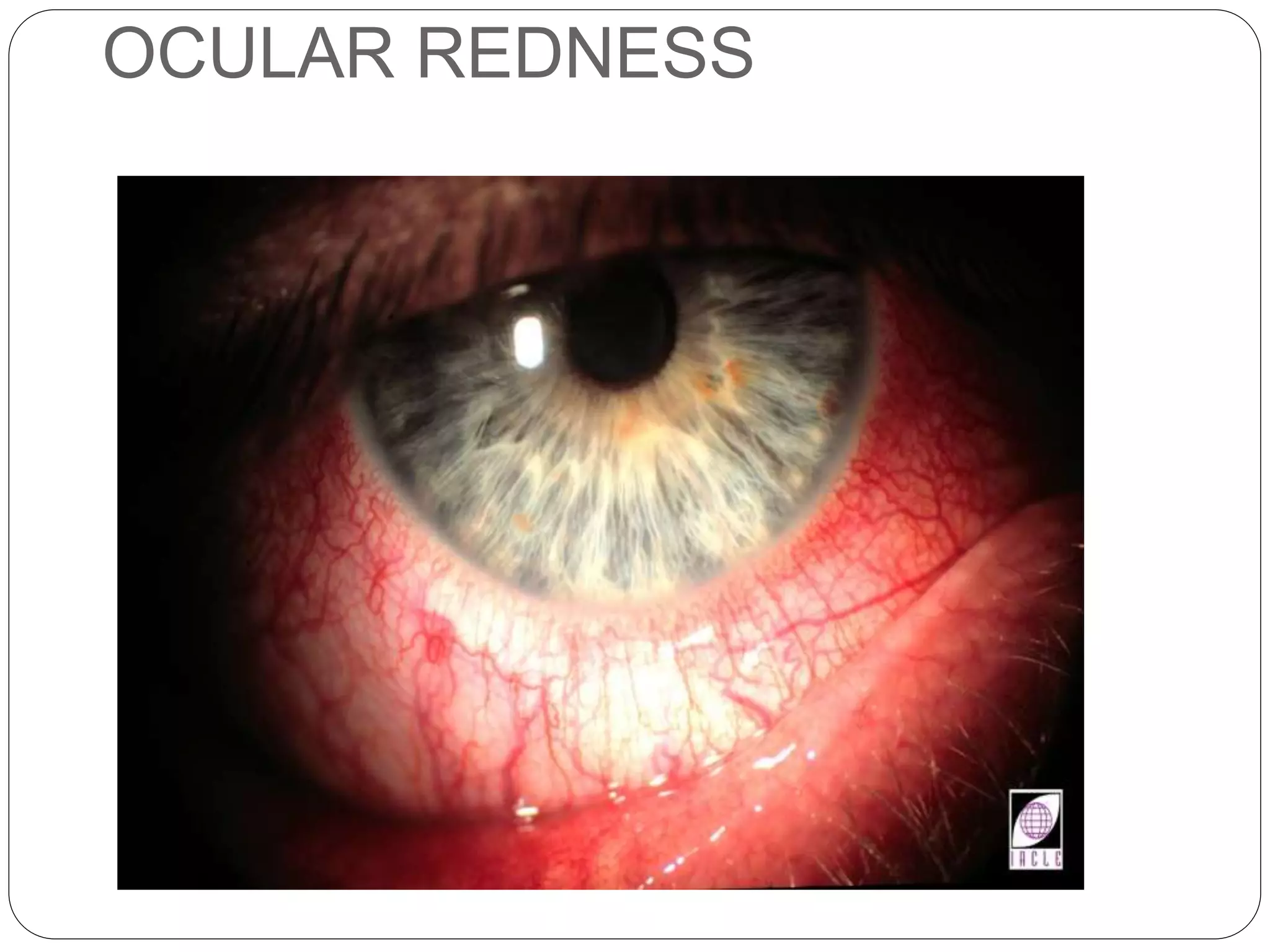 OCULAR REDNESS
SIGNS
 