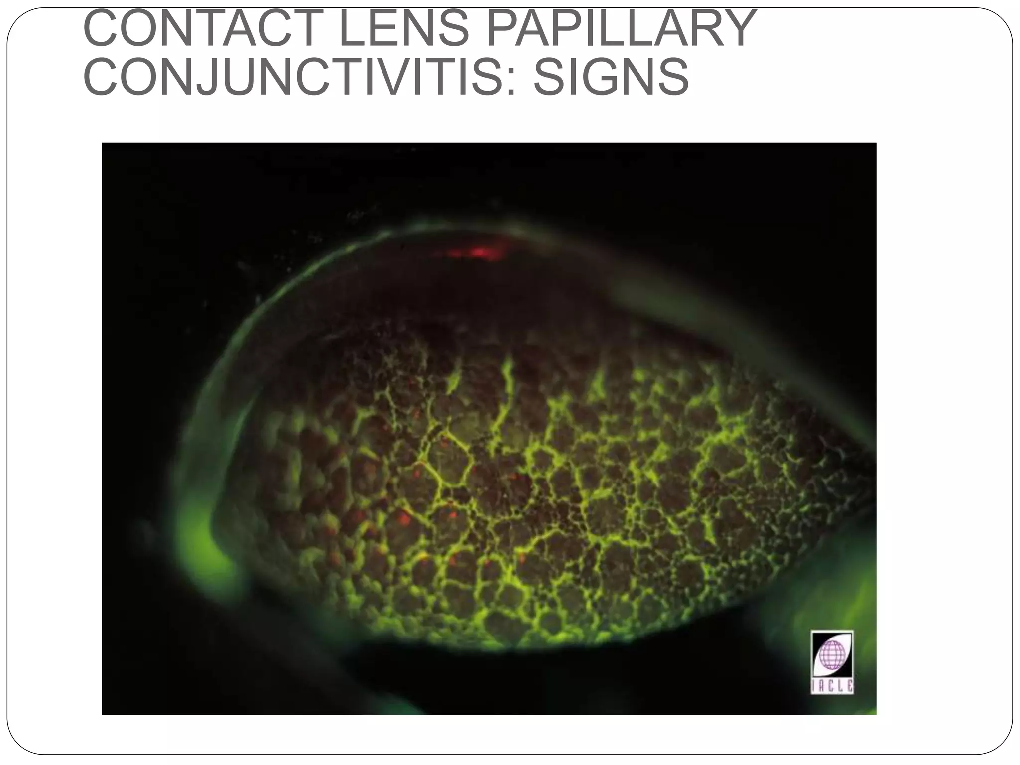 CONTACT LENS PAPILLARY
CONJUNCTIVITIS: SIGNS
 