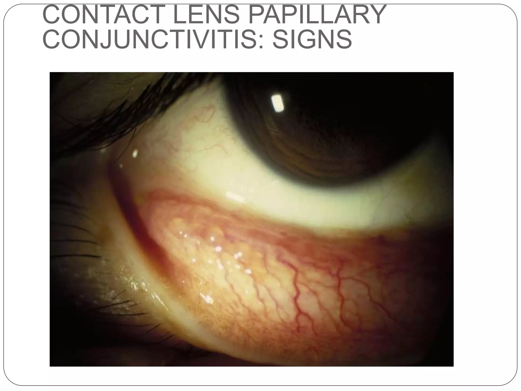 CONTACT LENS PAPILLARY
CONJUNCTIVITIS: SIGNS
 