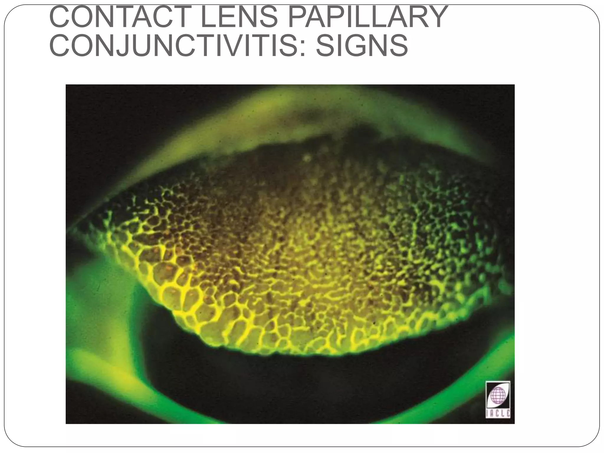 CONTACT LENS PAPILLARY
CONJUNCTIVITIS: SIGNS
 
