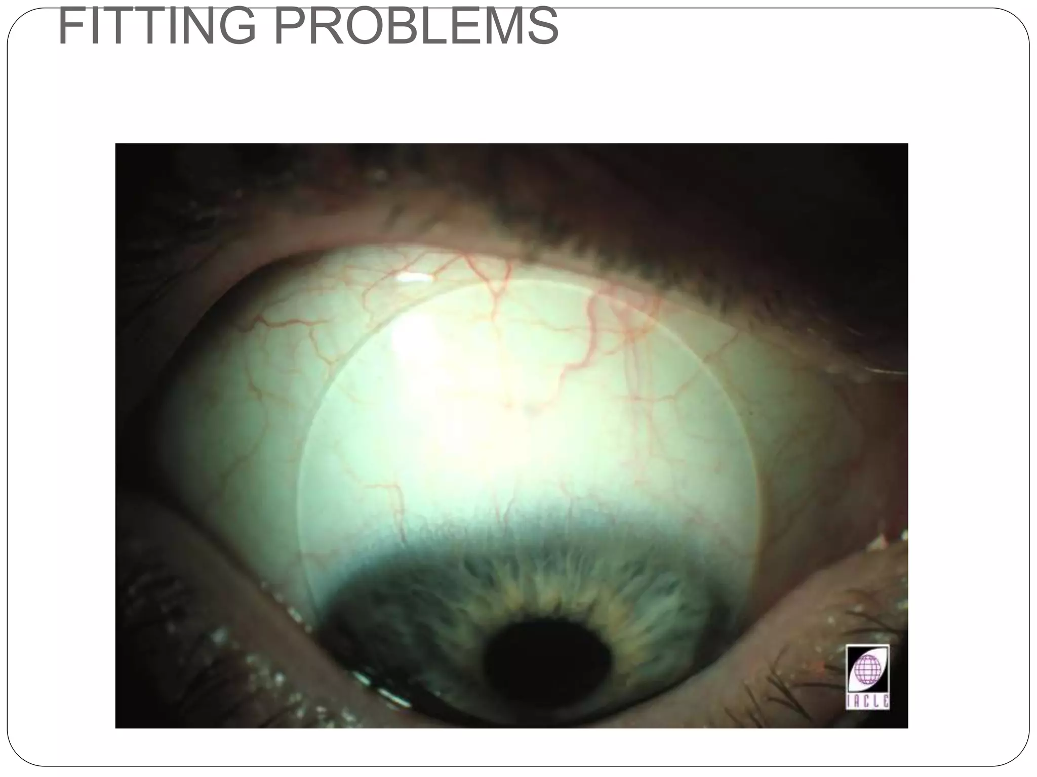 FITTING PROBLEMS
SIGNS
 