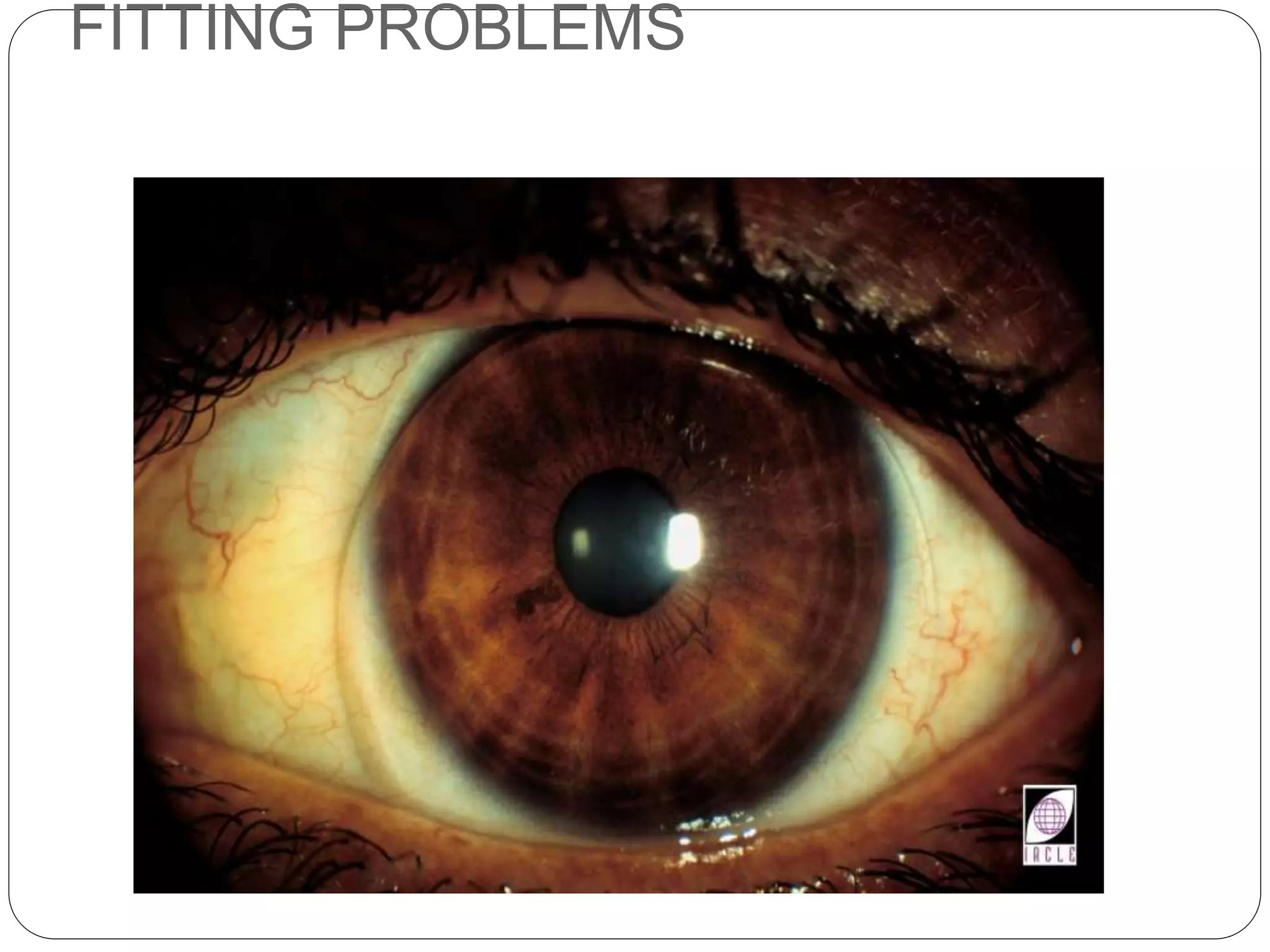 FITTING PROBLEMS
SIGNS
 