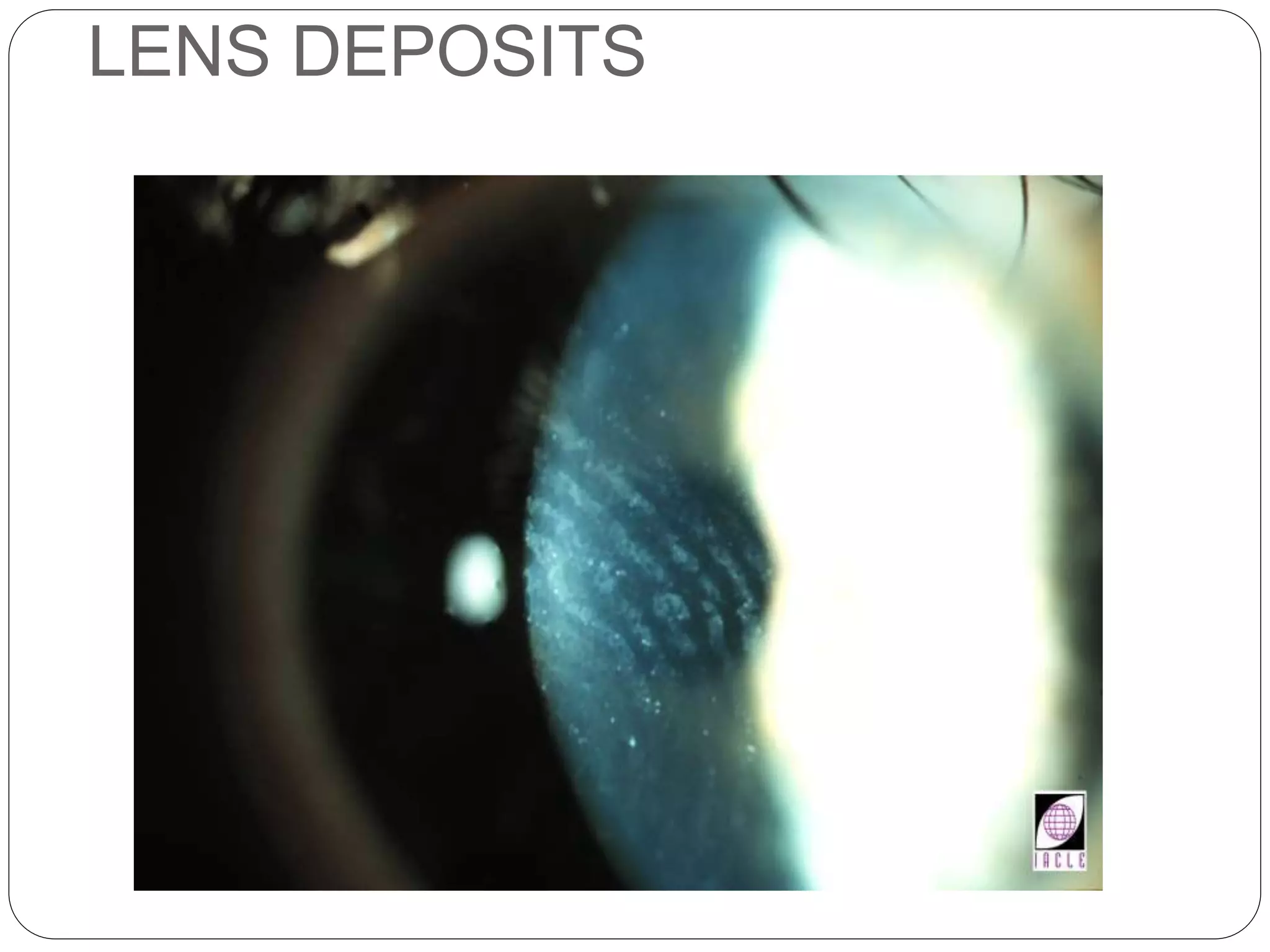 LENS DEPOSITS
SIGNS
 