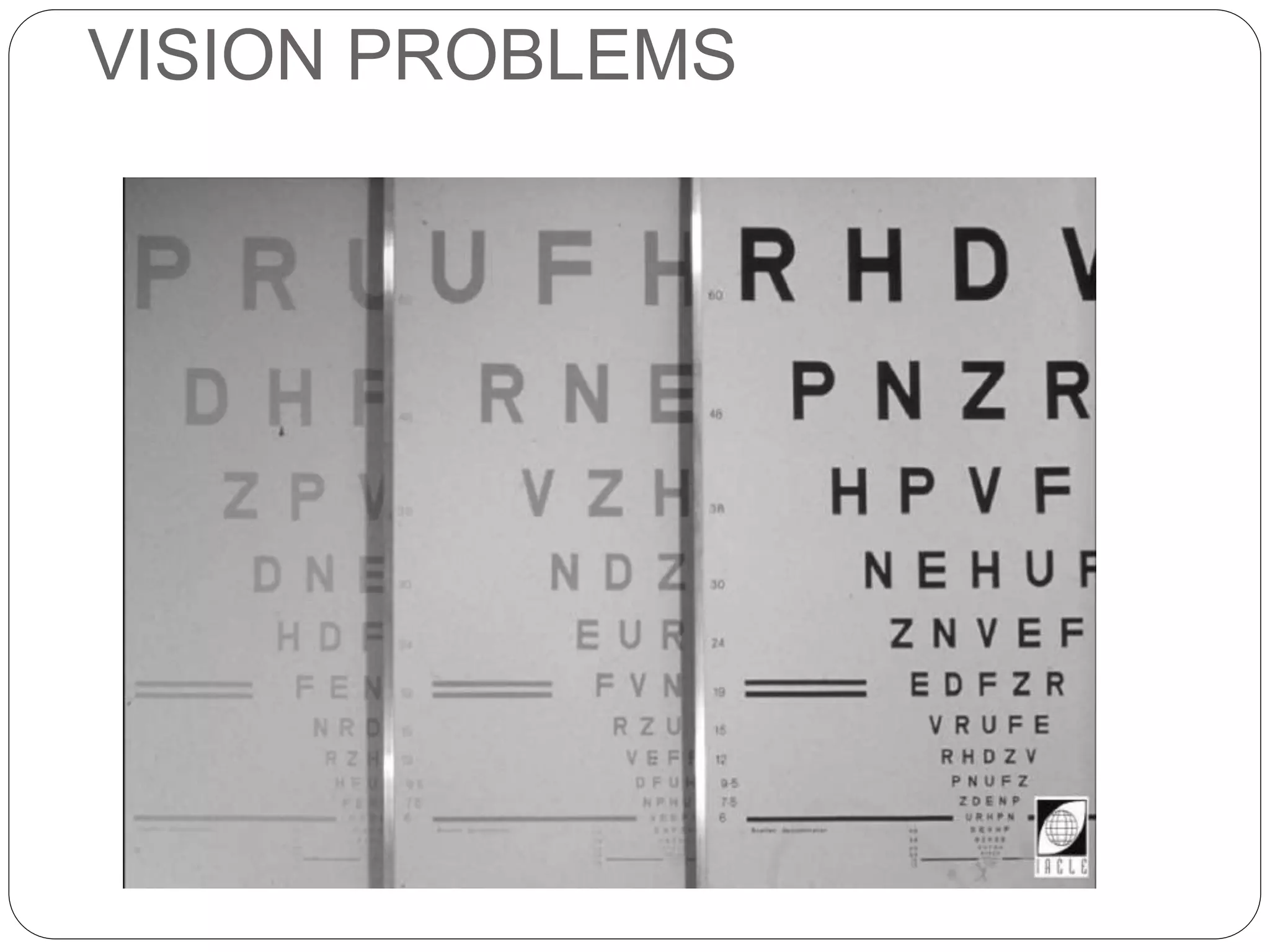 VISION PROBLEMS
SIGNS
 