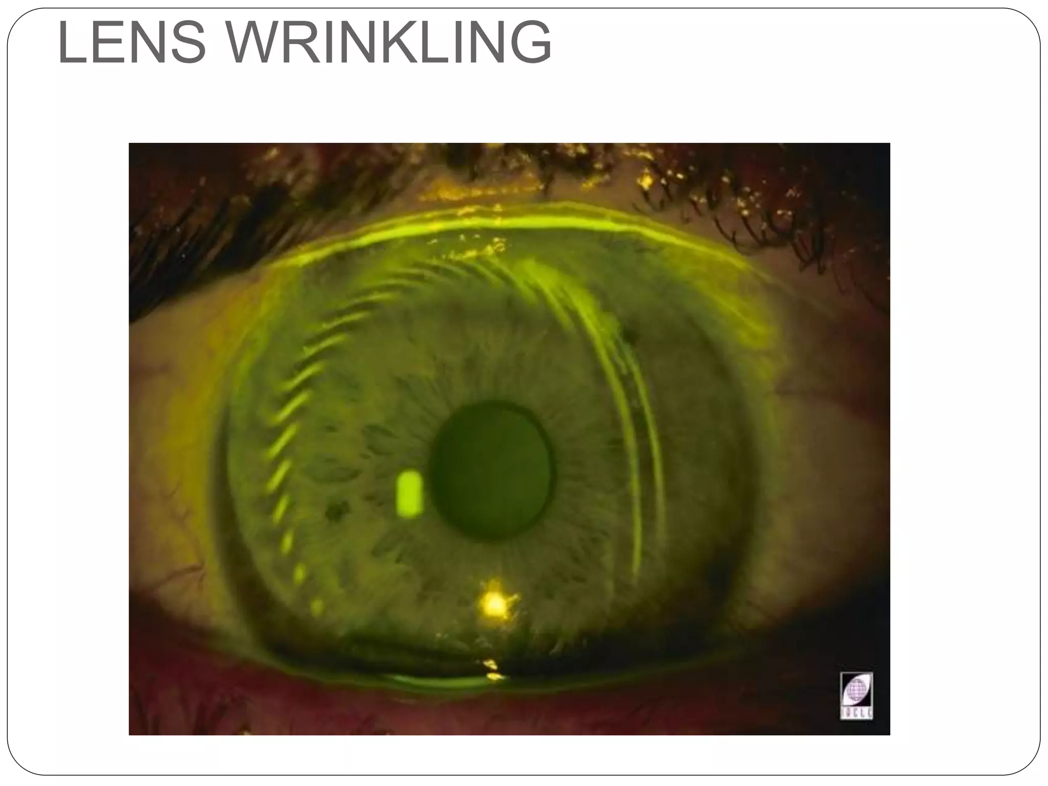 LENS WRINKLING
SIGNS
 