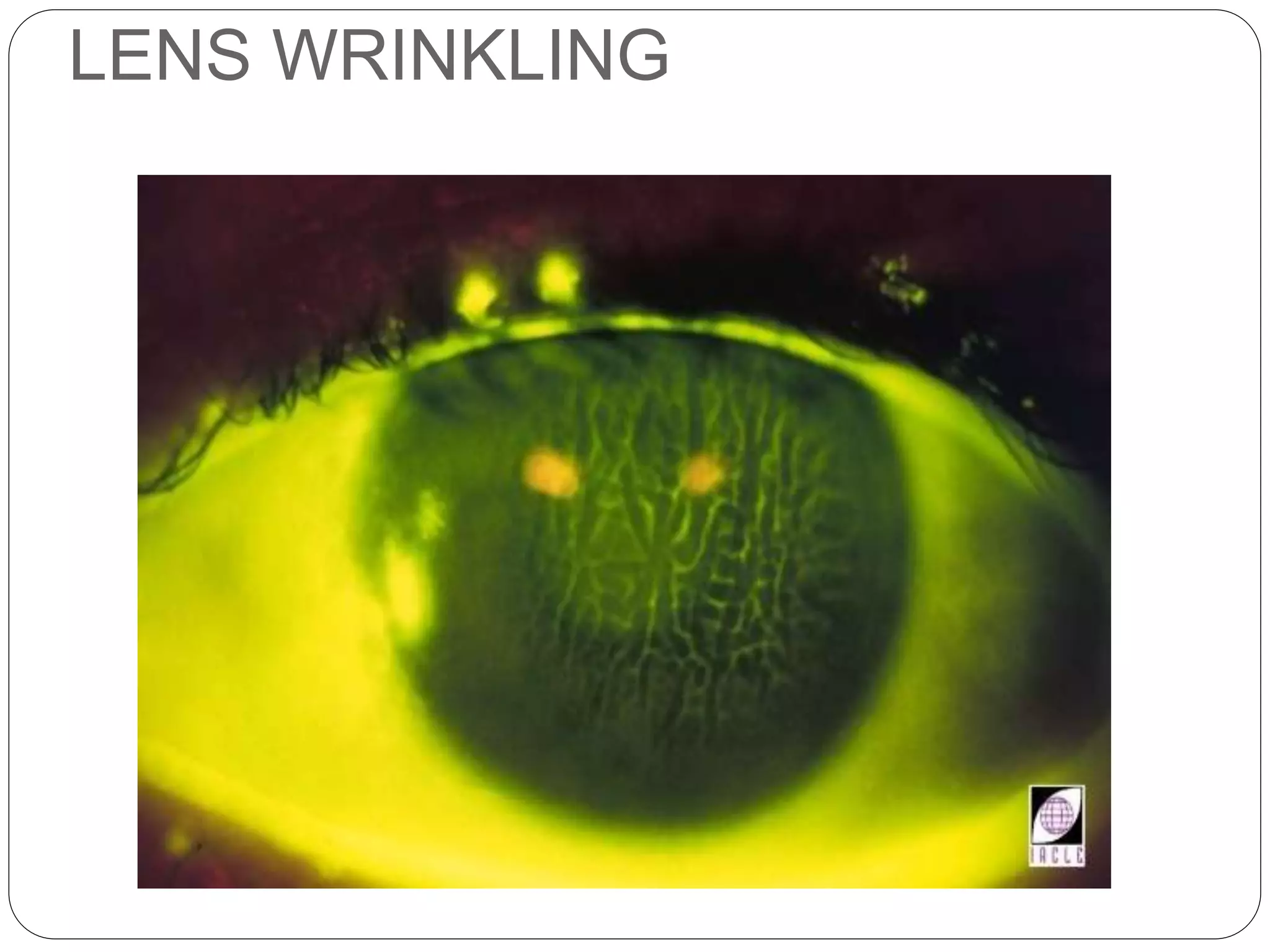 LENS WRINKLING
SIGNS
 