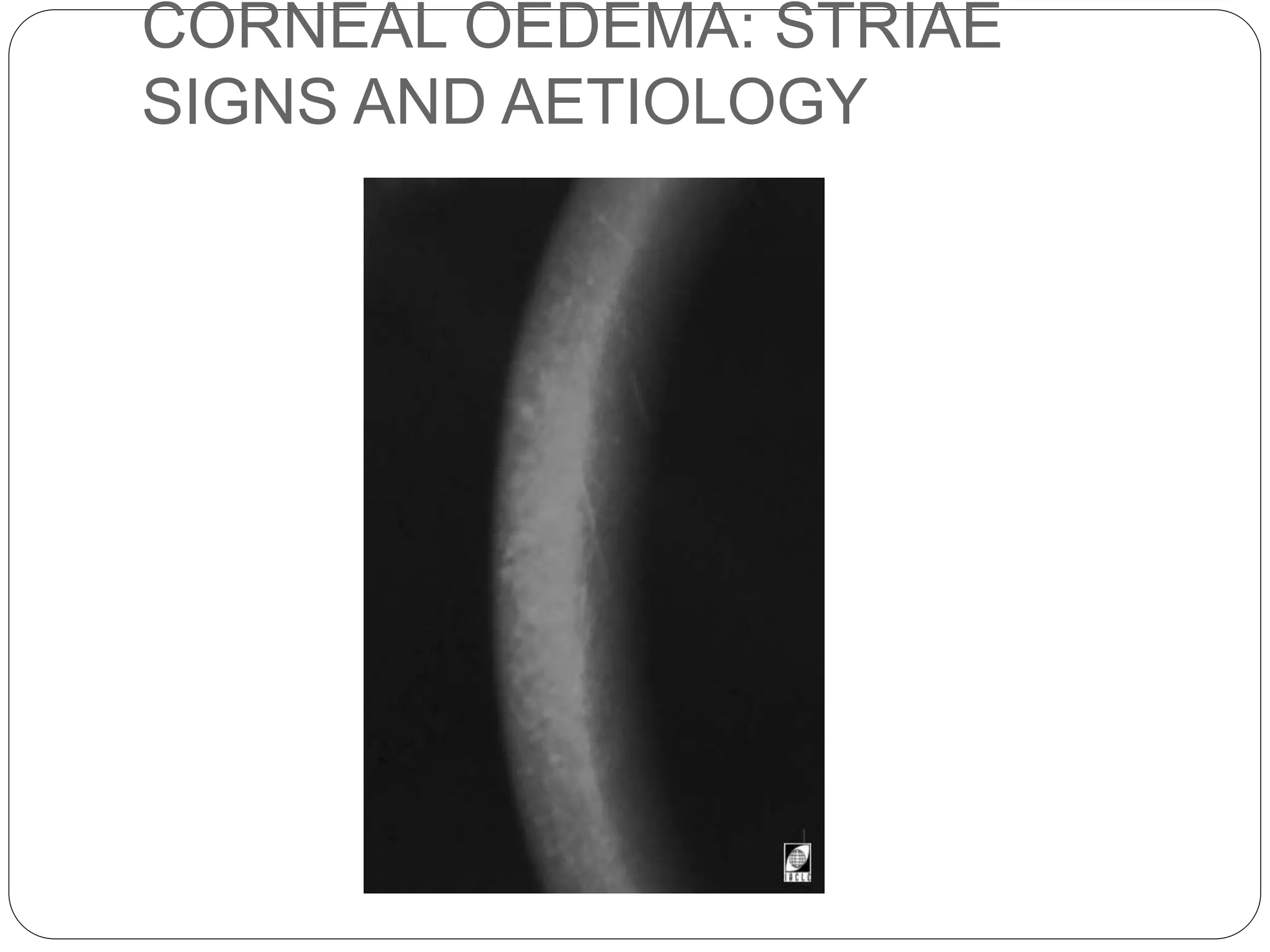 CORNEAL OEDEMA: STRIAE
SIGNS AND AETIOLOGY
 