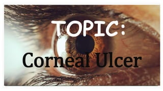 TOPIC:
Corneal Ulcer
 