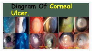 Diagram Of Corneal
Ulcer.
 