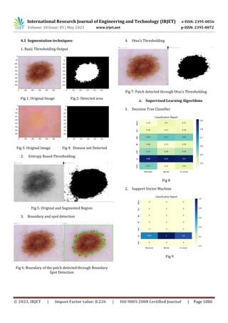 International Research Journal of Engineering and Technology (IRJET) e-ISSN: 2395-0056
Volume: 10 Issue: 05 | May 2023 www.irjet.net p-ISSN: 2395-0072
© 2023, IRJET | Impact Factor value: 8.226 | ISO 9001:2008 Certified Journal | Page 1086
4.1 Segmentation techniques:
1. Basic Thresholding Output
Fig 1: Original Image Fig 2: Detected area
Fig 3: Original Image Fig 4: Disease not Detected
2. Entropy Based Thresholding
Fig 5: Original and Segmented Region
3. Boundary and spot detection
Fig 6: Boundary of the patch detected through Boundary
Spot Detection
4. Otsu’s Thresholding
Fig 7: Patch detected through Otsu’s Thresholding
a. Supervised Learning Algorithms
1. Decision Tree Classifier
Fig 8
2. Support Vector Machine
Fig 9
 