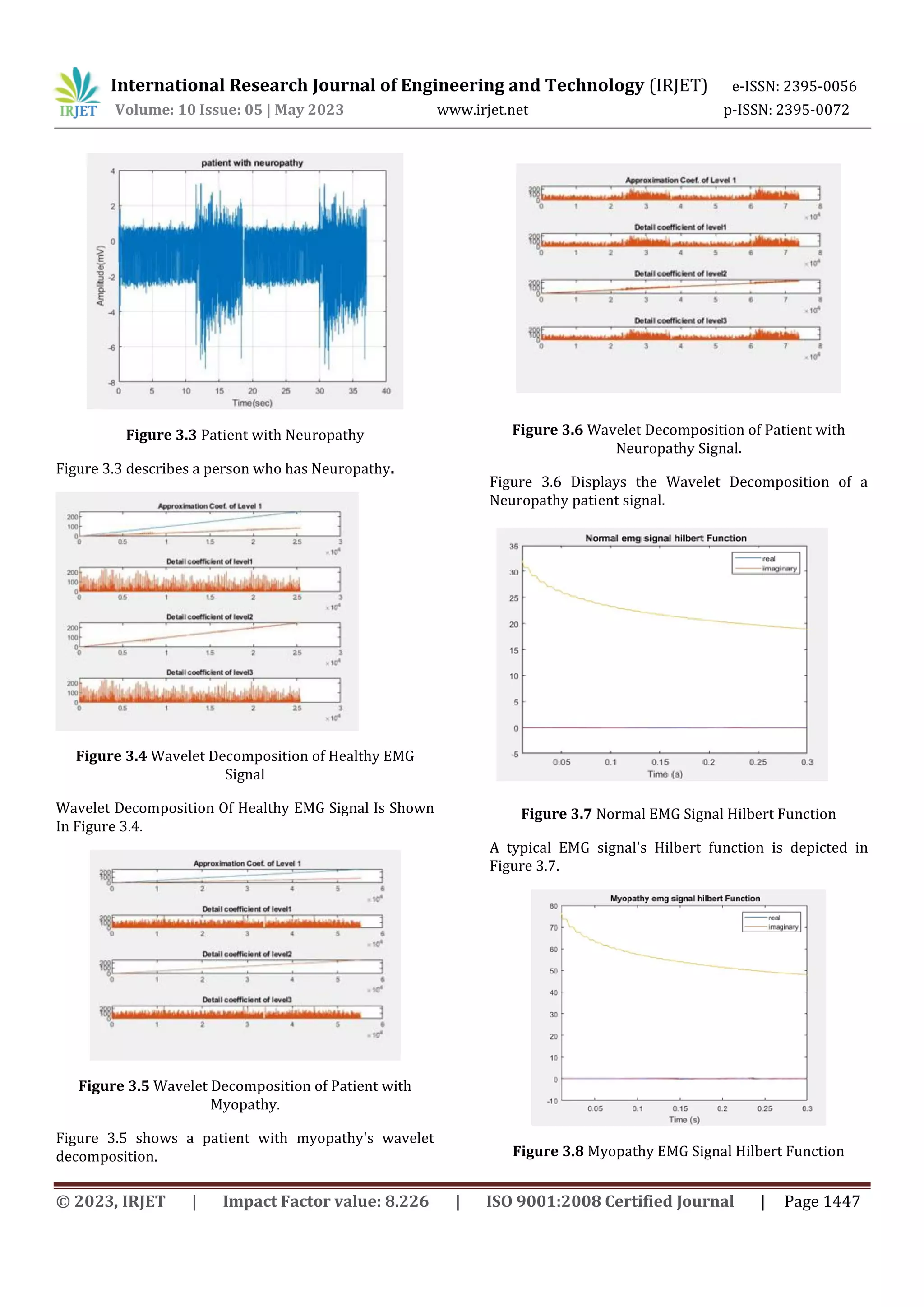 International Research Journal of Engineering and Technology (IRJET) e-ISSN: 2395-0056
Volume: 10 Issue: 05 | May 2023 www.irjet.net p-ISSN: 2395-0072
© 2023, IRJET | Impact Factor value: 8.226 | ISO 9001:2008 Certified Journal | Page 1447
Figure 3.3 Patient with Neuropathy
Figure 3.3 describes a person who has Neuropathy.
Figure 3.4 Wavelet Decomposition of Healthy EMG
Signal
Wavelet Decomposition Of Healthy EMG Signal Is Shown
In Figure 3.4.
Figure 3.5 Wavelet Decomposition of Patient with
Myopathy.
Figure 3.5 shows a patient with myopathy's wavelet
decomposition.
Figure 3.6 Wavelet Decomposition of Patient with
Neuropathy Signal.
Figure 3.6 Displays the Wavelet Decomposition of a
Neuropathy patient signal.
Figure 3.7 Normal EMG Signal Hilbert Function
A typical EMG signal's Hilbert function is depicted in
Figure 3.7.
Figure 3.8 Myopathy EMG Signal Hilbert Function
 