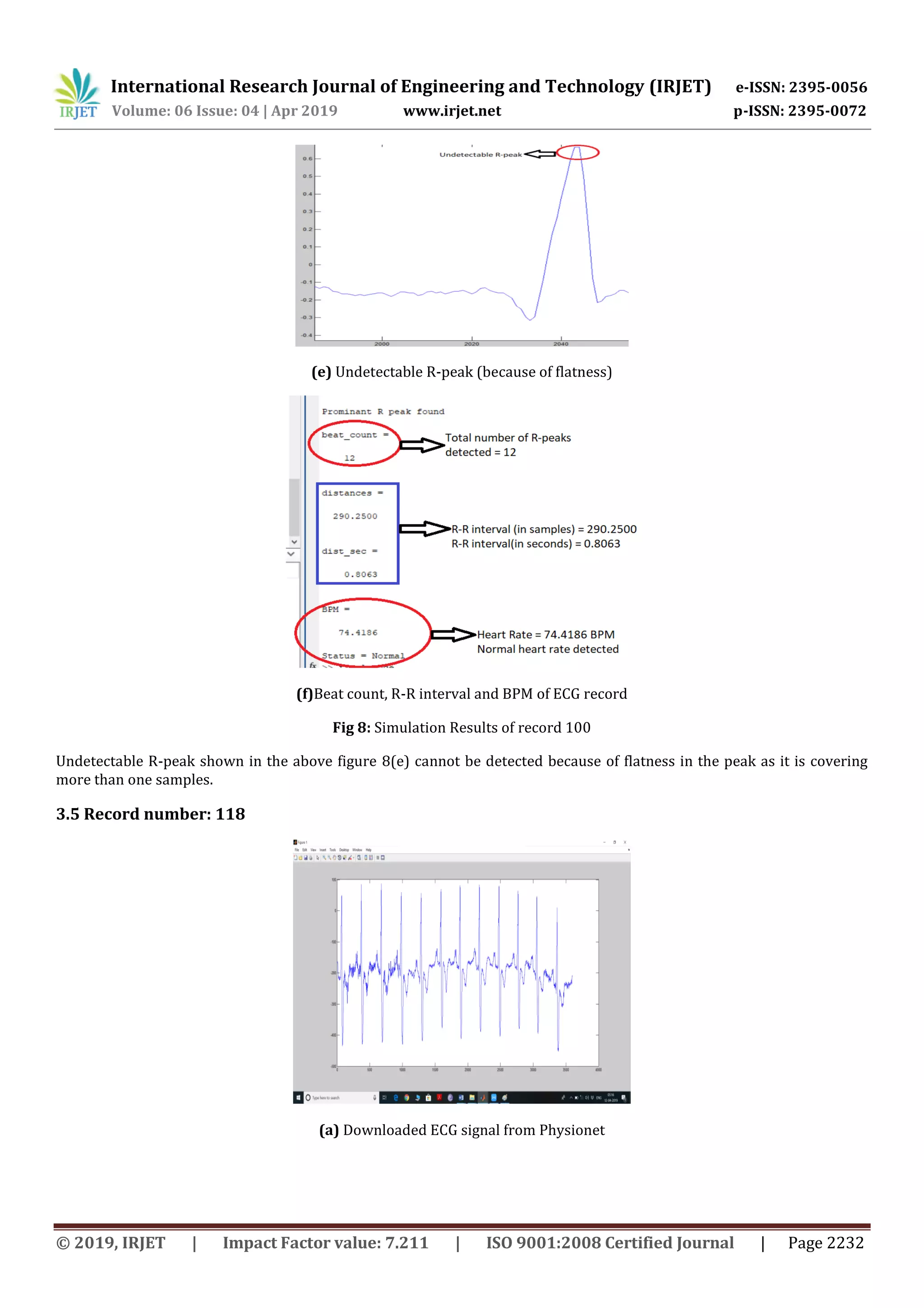 International Research Journal of Engineering and Technology (IRJET) e-ISSN: 2395-0056
Volume: 06 Issue: 04 | Apr 2019 www.irjet.net p-ISSN: 2395-0072
© 2019, IRJET | Impact Factor value: 7.211 | ISO 9001:2008 Certified Journal | Page 2232
(e) Undetectable R-peak (because of flatness)
(f)Beat count, R-R interval and BPM of ECG record
Fig 8: Simulation Results of record 100
Undetectable R-peak shown in the above figure 8(e) cannot be detected because of flatness in the peak as it is covering
more than one samples.
3.5 Record number: 118
(a) Downloaded ECG signal from Physionet
 