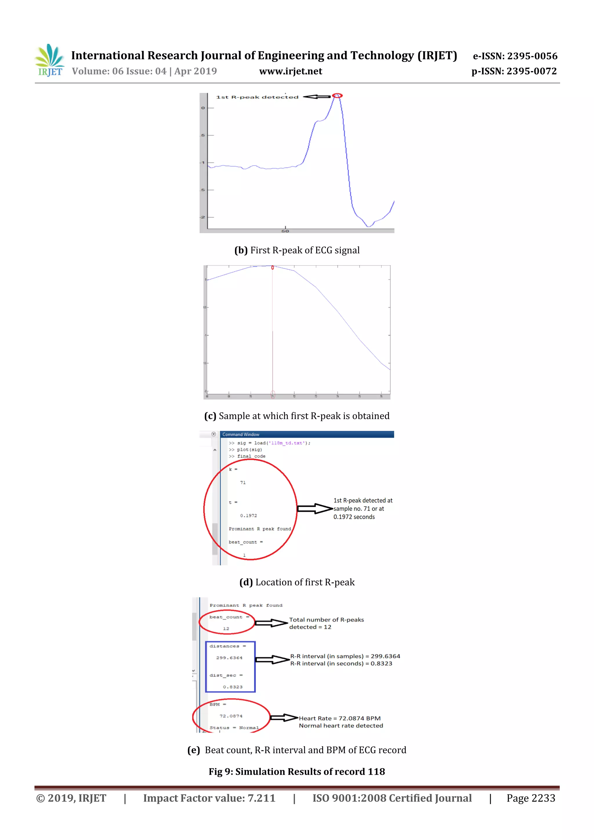 International Research Journal of Engineering and Technology (IRJET) e-ISSN: 2395-0056
Volume: 06 Issue: 04 | Apr 2019 www.irjet.net p-ISSN: 2395-0072
© 2019, IRJET | Impact Factor value: 7.211 | ISO 9001:2008 Certified Journal | Page 2233
(b) First R-peak of ECG signal
(c) Sample at which first R-peak is obtained
(d) Location of first R-peak
(e) Beat count, R-R interval and BPM of ECG record
Fig 9: Simulation Results of record 118
 