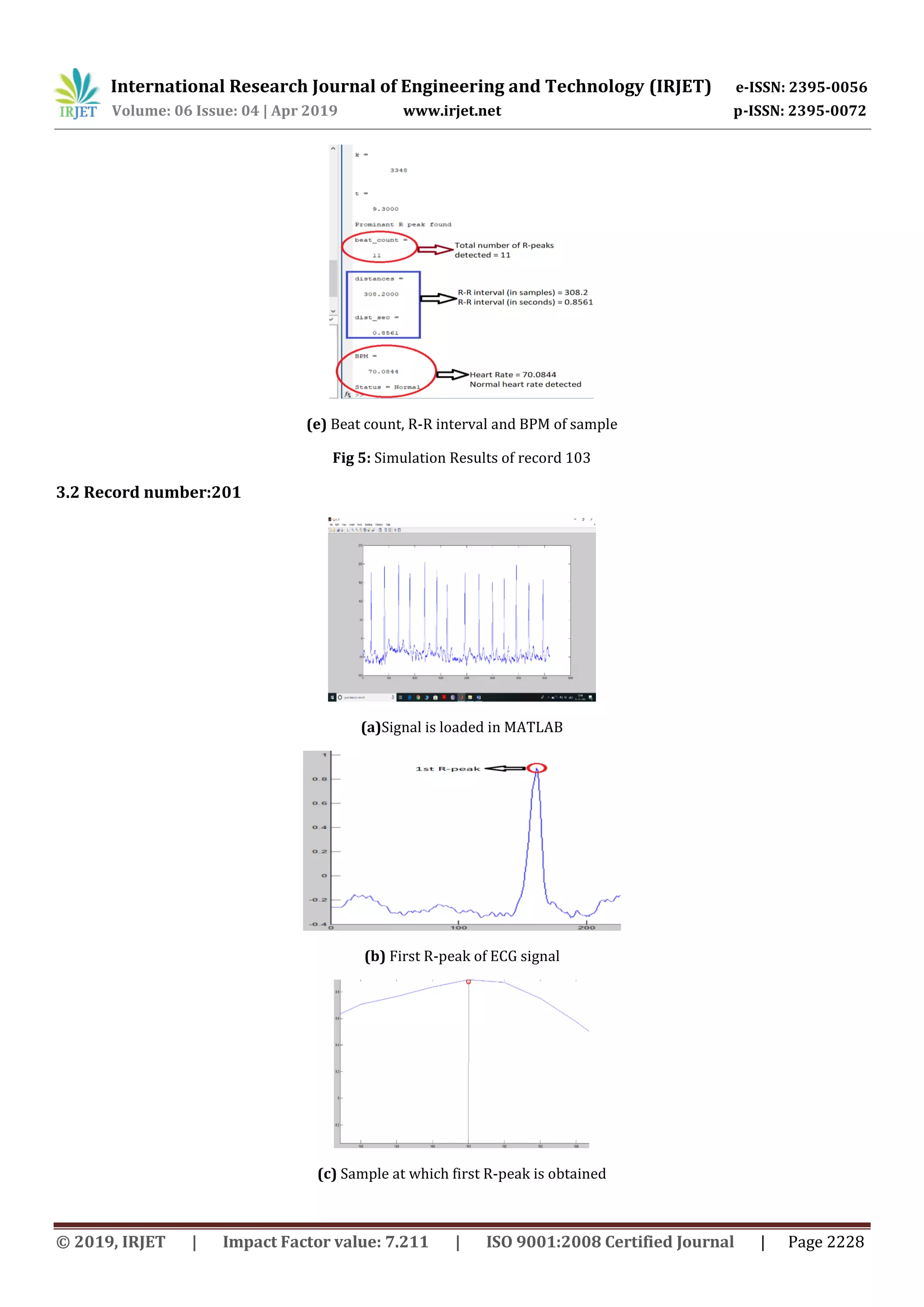 International Research Journal of Engineering and Technology (IRJET) e-ISSN: 2395-0056
Volume: 06 Issue: 04 | Apr 2019 www.irjet.net p-ISSN: 2395-0072
© 2019, IRJET | Impact Factor value: 7.211 | ISO 9001:2008 Certified Journal | Page 2228
(e) Beat count, R-R interval and BPM of sample
Fig 5: Simulation Results of record 103
3.2 Record number:201
(a)Signal is loaded in MATLAB
(b) First R-peak of ECG signal
(c) Sample at which first R-peak is obtained
 