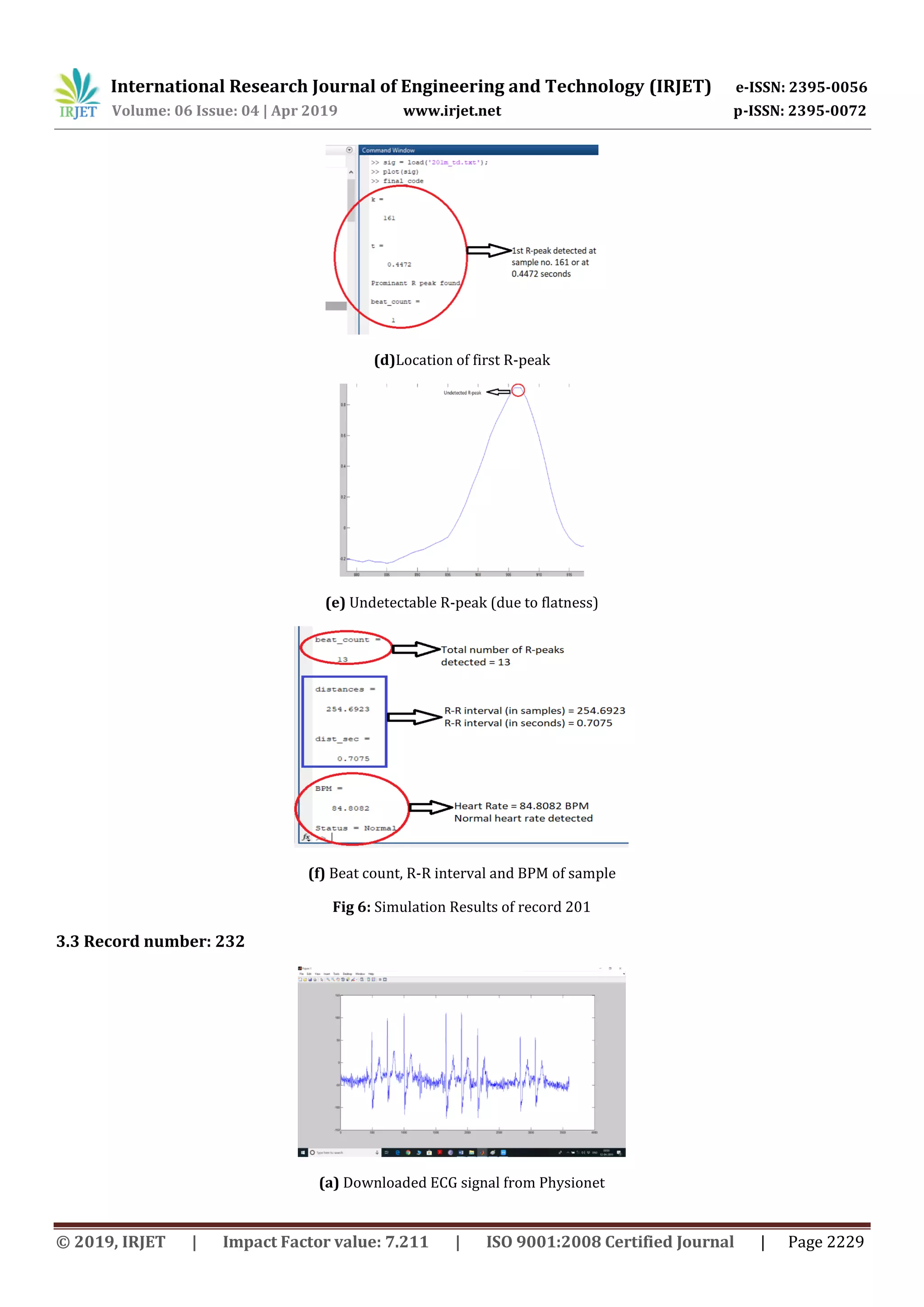 International Research Journal of Engineering and Technology (IRJET) e-ISSN: 2395-0056
Volume: 06 Issue: 04 | Apr 2019 www.irjet.net p-ISSN: 2395-0072
© 2019, IRJET | Impact Factor value: 7.211 | ISO 9001:2008 Certified Journal | Page 2229
(d)Location of first R-peak
(e) Undetectable R-peak (due to flatness)
(f) Beat count, R-R interval and BPM of sample
Fig 6: Simulation Results of record 201
3.3 Record number: 232
(a) Downloaded ECG signal from Physionet
 