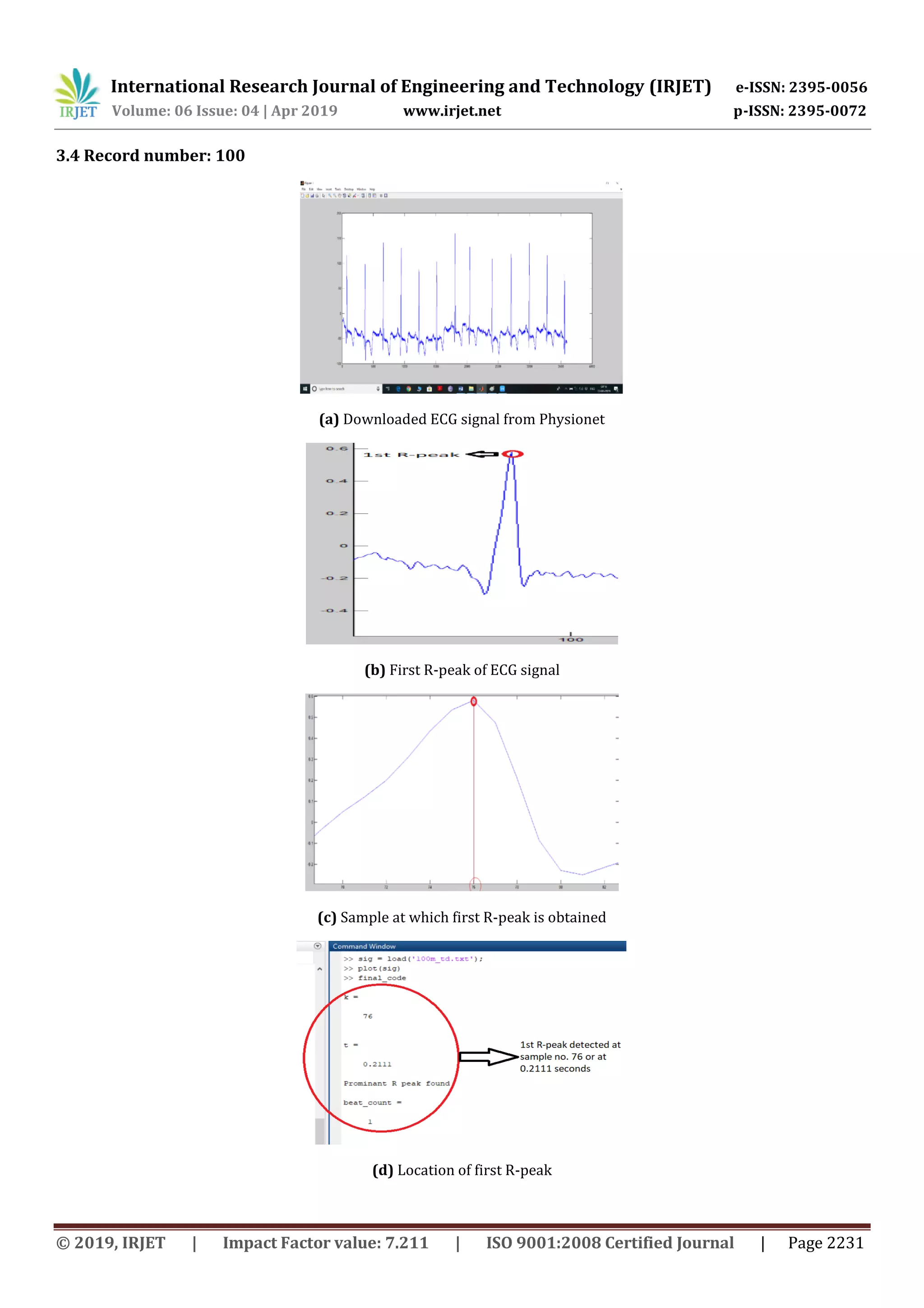 International Research Journal of Engineering and Technology (IRJET) e-ISSN: 2395-0056
Volume: 06 Issue: 04 | Apr 2019 www.irjet.net p-ISSN: 2395-0072
© 2019, IRJET | Impact Factor value: 7.211 | ISO 9001:2008 Certified Journal | Page 2231
3.4 Record number: 100
(a) Downloaded ECG signal from Physionet
(b) First R-peak of ECG signal
(c) Sample at which first R-peak is obtained
(d) Location of first R-peak
 