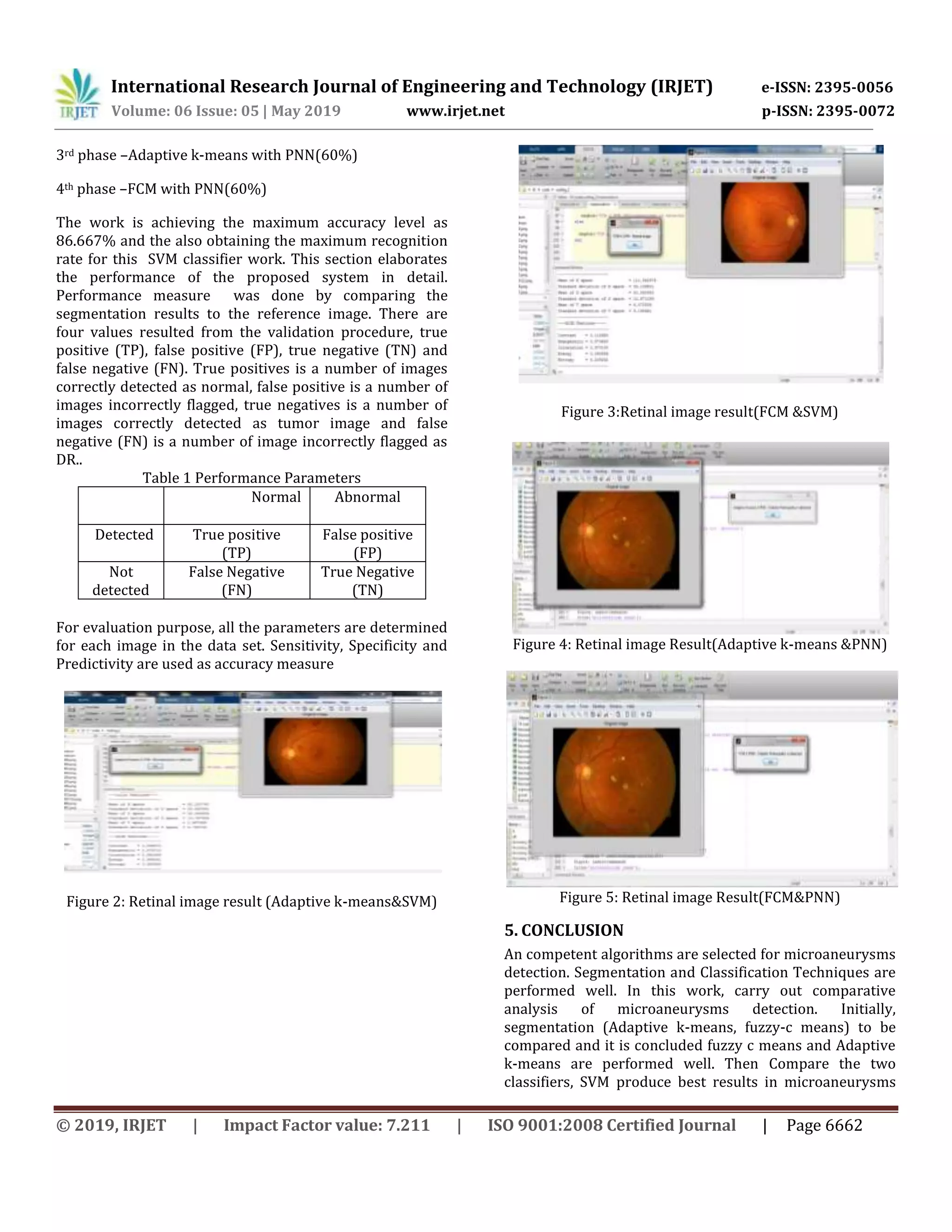 International Research Journal of Engineering and Technology (IRJET) e-ISSN: 2395-0056
Volume: 06 Issue: 05 | May 2019 www.irjet.net p-ISSN: 2395-0072
© 2019, IRJET | Impact Factor value: 7.211 | ISO 9001:2008 Certified Journal | Page 6662
3rd phase –Adaptive k-means with PNN(60%)
4th phase –FCM with PNN(60%)
The work is achieving the maximum accuracy level as
86.667% and the also obtaining the maximum recognition
rate for this SVM classifier work. This section elaborates
the performance of the proposed system in detail.
Performance measure was done by comparing the
segmentation results to the reference image. There are
four values resulted from the validation procedure, true
positive (TP), false positive (FP), true negative (TN) and
false negative (FN). True positives is a number of images
correctly detected as normal, false positive is a number of
images incorrectly flagged, true negatives is a number of
images correctly detected as tumor image and false
negative (FN) is a number of image incorrectly flagged as
DR..
Table 1 Performance Parameters
Normal Abnormal
Detected True positive
(TP)
False positive
(FP)
Not
detected
False Negative
(FN)
True Negative
(TN)
For evaluation purpose, all the parameters are determined
for each image in the data set. Sensitivity, Specificity and
Predictivity are used as accuracy measure
Figure 2: Retinal image result (Adaptive k-means&SVM)
Figure 3:Retinal image result(FCM &SVM)
Figure 4: Retinal image Result(Adaptive k-means &PNN)
Figure 5: Retinal image Result(FCM&PNN)
5. CONCLUSION
An competent algorithms are selected for microaneurysms
detection. Segmentation and Classification Techniques are
performed well. In this work, carry out comparative
analysis of microaneurysms detection. Initially,
segmentation (Adaptive k-means, fuzzy-c means) to be
compared and it is concluded fuzzy c means and Adaptive
k-means are performed well. Then Compare the two
classifiers, SVM produce best results in microaneurysms
 