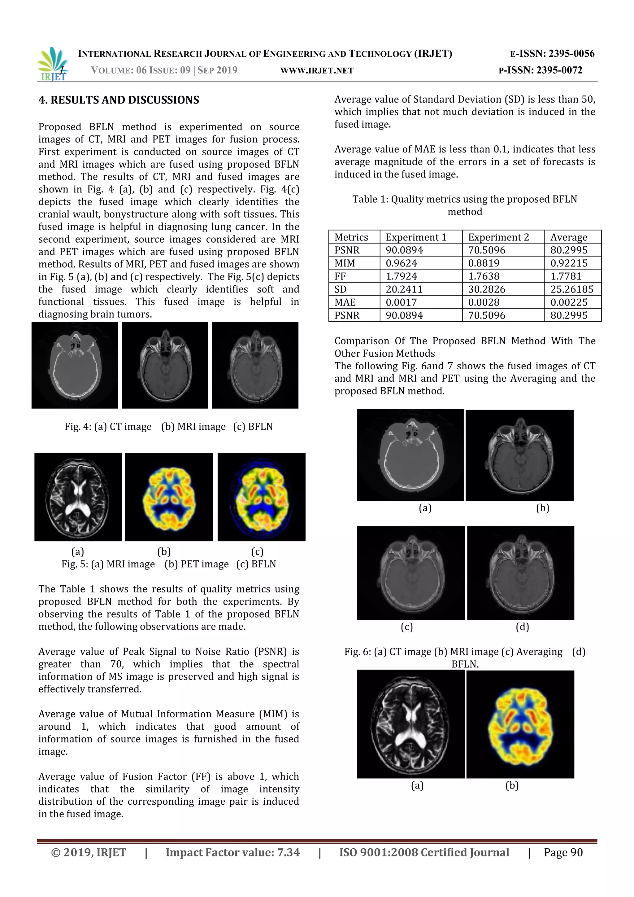 INTERNATIONAL RESEARCH JOURNAL OF ENGINEERING AND TECHNOLOGY (IRJET) E-ISSN: 2395-0056
I. VOLUME: 06 ISSUE: 09 | SEP 2019 WWW.IRJET.NET P-ISSN: 2395-0072
© 2019, IRJET | Impact Factor value: 7.34 | ISO 9001:2008 Certified Journal | Page 90
4. RESULTS AND DISCUSSIONS
Proposed BFLN method is experimented on source
images of CT, MRI and PET images for fusion process.
First experiment is conducted on source images of CT
and MRI images which are fused using proposed BFLN
method. The results of CT, MRI and fused images are
shown in Fig. 4 (a), (b) and (c) respectively. Fig. 4(c)
depicts the fused image which clearly identifies the
cranial wault, bonystructure along with soft tissues. This
fused image is helpful in diagnosing lung cancer. In the
second experiment, source images considered are MRI
and PET images which are fused using proposed BFLN
method. Results of MRI, PET and fused images are shown
in Fig. 5 (a), (b) and (c) respectively. The Fig. 5(c) depicts
the fused image which clearly identifies soft and
functional tissues. This fused image is helpful in
diagnosing brain tumors.
(a) (b) (c)
Fig. 4: (a) CT image (b) MRI image (c) BFLN
(a) (b) (c)
Fig. 5: (a) MRI image (b) PET image (c) BFLN
The Table 1 shows the results of quality metrics using
proposed BFLN method for both the experiments. By
observing the results of Table 1 of the proposed BFLN
method, the following observations are made.
Average value of Peak Signal to Noise Ratio (PSNR) is
greater than 70, which implies that the spectral
information of MS image is preserved and high signal is
effectively transferred.
Average value of Mutual Information Measure (MIM) is
around 1, which indicates that good amount of
information of source images is furnished in the fused
image.
Average value of Fusion Factor (FF) is above 1, which
indicates that the similarity of image intensity
distribution of the corresponding image pair is induced
in the fused image.
Average value of Standard Deviation (SD) is less than 50,
which implies that not much deviation is induced in the
fused image.
Average value of MAE is less than 0.1, indicates that less
average magnitude of the errors in a set of forecasts is
induced in the fused image.
Table 1: Quality metrics using the proposed BFLN
method
Metrics Experiment 1 Experiment 2 Average
PSNR 90.0894 70.5096 80.2995
MIM 0.9624 0.8819 0.92215
FF 1.7924 1.7638 1.7781
SD 20.2411 30.2826 25.26185
MAE 0.0017 0.0028 0.00225
PSNR 90.0894 70.5096 80.2995
Comparison Of The Proposed BFLN Method With The
Other Fusion Methods
The following Fig. 6and 7 shows the fused images of CT
and MRI and MRI and PET using the Averaging and the
proposed BFLN method.
(a) (b)
(c) (d)
Fig. 6: (a) CT image (b) MRI image (c) Averaging (d)
BFLN.
(a) (b)
 
