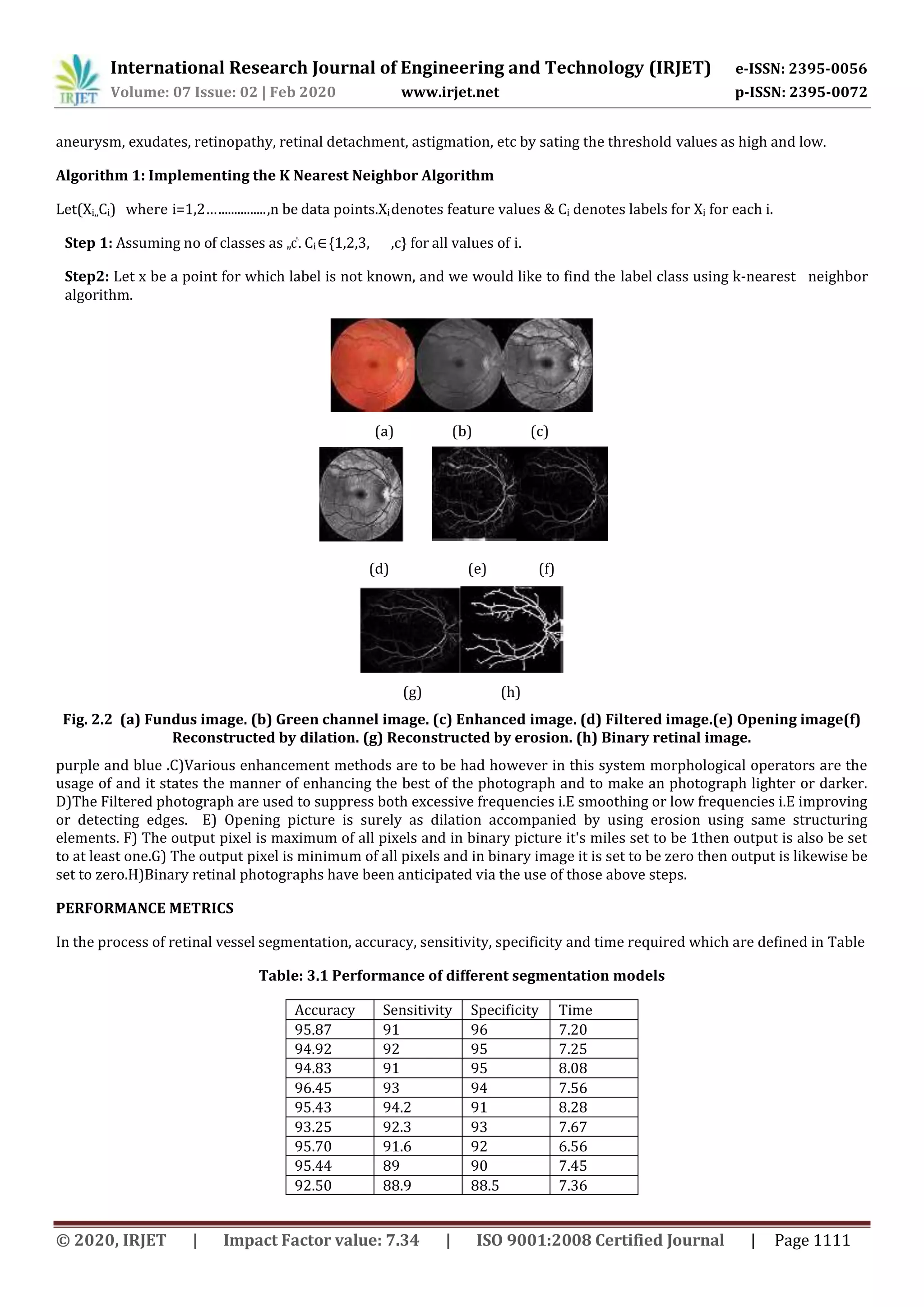 International Research Journal of Engineering and Technology (IRJET) e-ISSN: 2395-0056
Volume: 07 Issue: 02 | Feb 2020 www.irjet.net p-ISSN: 2395-0072
© 2020, IRJET | Impact Factor value: 7.34 | ISO 9001:2008 Certified Journal | Page 1111
aneurysm, exudates, retinopathy, retinal detachment, astigmation, etc by sating the threshold values as high and low.
Algorithm 1: Implementing the K Nearest Neighbor Algorithm
Let(Xi,,Ci) where i=1,2…...............,n be data points.Xidenotes feature values & Ci denotes labels for Xi for each i.
Step 1: Assuming no of classes as „c‟. Ci∈{1,2,3, ,c} for all values of i.
Step2: Let x be a point for which label is not known, and we would like to find the label class using k-nearest neighbor
algorithm.
(a) (b) (c)
(d) (e) (f)
(g) (h)
Fig. 2.2 (a) Fundus image. (b) Green channel image. (c) Enhanced image. (d) Filtered image.(e) Opening image(f)
Reconstructed by dilation. (g) Reconstructed by erosion. (h) Binary retinal image.
purple and blue .C)Various enhancement methods are to be had however in this system morphological operators are the
usage of and it states the manner of enhancing the best of the photograph and to make an photograph lighter or darker.
D)The Filtered photograph are used to suppress both excessive frequencies i.E smoothing or low frequencies i.E improving
or detecting edges. E) Opening picture is surely as dilation accompanied by using erosion using same structuring
elements. F) The output pixel is maximum of all pixels and in binary picture it's miles set to be 1then output is also be set
to at least one.G) The output pixel is minimum of all pixels and in binary image it is set to be zero then output is likewise be
set to zero.H)Binary retinal photographs have been anticipated via the use of those above steps.
PERFORMANCE METRICS
In the process of retinal vessel segmentation, accuracy, sensitivity, specificity and time required which are defined in Table
Table: 3.1 Performance of different segmentation models
Accuracy Sensitivity Specificity Time
95.87 91 96 7.20
94.92 92 95 7.25
94.83 91 95 8.08
96.45 93 94 7.56
95.43 94.2 91 8.28
93.25 92.3 93 7.67
95.70 91.6 92 6.56
95.44 89 90 7.45
92.50 88.9 88.5 7.36
 