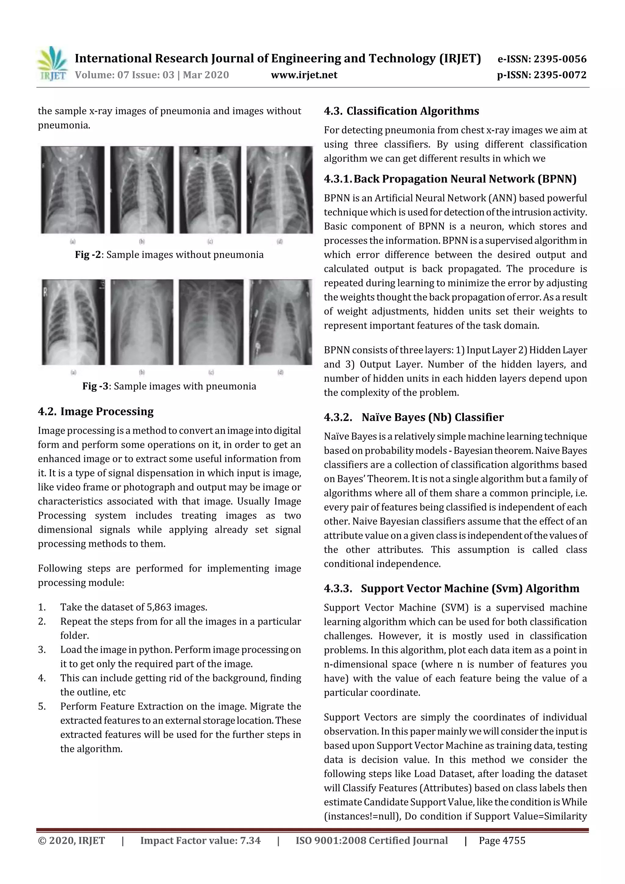 IRJET - Detecting Pneumonia from Chest X-Ray Images using Committee Machine