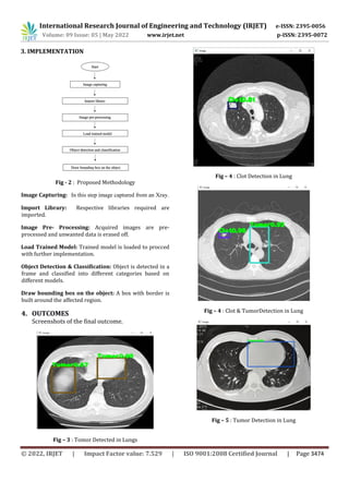 Lung Cancer Detection using Convolutional Neural Network | PDF