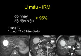 U máu - IRM
độ nhạy
độ đặc hiệu
* xung T2
* xung T1 có tiêm Gado
> 95%
 