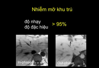 Nhiễm mỡ khu trú
độ nhạy
độ đặc hiệu
> 95%
In-phase Out-phase
 
