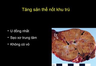 • U đồng nhất
• Sẹo xơ trung tâm
• Không có vỏ
Tăng sản thể nốt khu trú
 