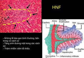 - Những tế bào gan bình thường, bên
trong có vách xơ
- Tăng sinh đường mật trong các vách
xơ
- Thâm nhiễm viêm tối thiểu
HNF
 