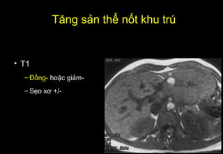 • T1
– Đồng- hoặc giảm-
– Sẹo xơ +/-
Tăng sản thể nốt khu trú
 