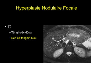 • T2
– Tăng hoặc đồng
– Sẹo xơ tăng tín hiệu
Hyperplasie Nodulaire Focale
 