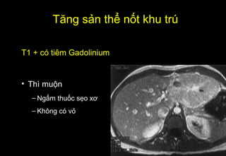 T1 + có tiêm Gadolinium
• Thì muộn
– Ngấm thuốc sẹo xơ
– Không có vỏ
Tăng sản thể nốt khu trú
 