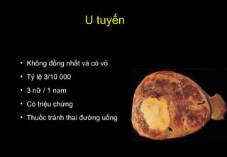 • Không đồng nhất và có vỏ
• Tỷ lệ 3/10 000
• 3 nữ / 1 nam
• Có triệu chứng
• Thuốc tránh thai đường uống
U tuyến
 
