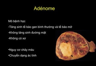 Mô bệnh học
-Tăng sinh tế bào gan bình thường và tế bào mỡ
-Không tăng sinh đường mật
-Không có xơ
•Nguy cơ chảy máu
•Chuyển dạng ác tính
Adénome
 