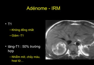 Adénome - IRM
• T1
– Không đồng nhất
– Giảm -T1
• tăng-T1 : 50% trường
hợp
– Nhiễm mỡ, chảy máu,
hoại tử…
 