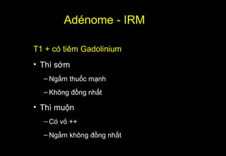 Adénome - IRM
T1 + có tiêm Gadolinium
• Thì sớm
– Ngấm thuốc mạnh
– Không đồng nhất
• Thì muộn
– Có vỏ ++
– Ngấm không đồng nhất
 