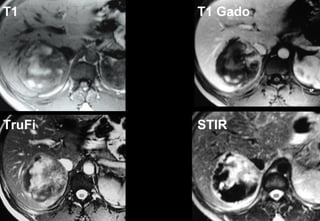 T1 T1 Gado
TruFi STIR
 