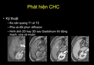 Phát hiện CHC
• Kỹ thuật
– Ko cản quang T1 et T2
– Pha và đối pha+ diffusion
– Hình ảnh 2D hay 3D sau Gadolinum thì động
mạch, cửa và muộn
 