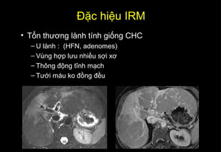 Đặc hiệu IRM
• Tổn thương lành tính giống CHC
– U lành : (HFN, adenomes)
– Vùng hợp lưu nhiều sợi xơ
– Thông động tĩnh mạch
– Tưới máu ko đồng đều
 