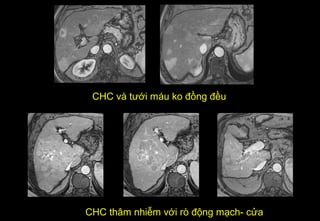 CHC và tưới máu ko đồng đều
CHC thâm nhiễm với rò động mạch- cửa
 