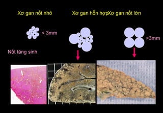 Xơ gan nốt nhỏ Xơ gan nốt lớnXơ gan hỗn hợp
< 3mm
>3mm
Nốt tăng sinh
 