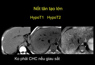 HypoT1 HypoT2
Ko phải CHC nếu giau sắt
Nốt tân tạo lớn
 